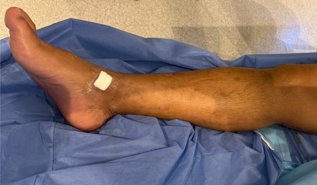 VenaSeal: técnica actual